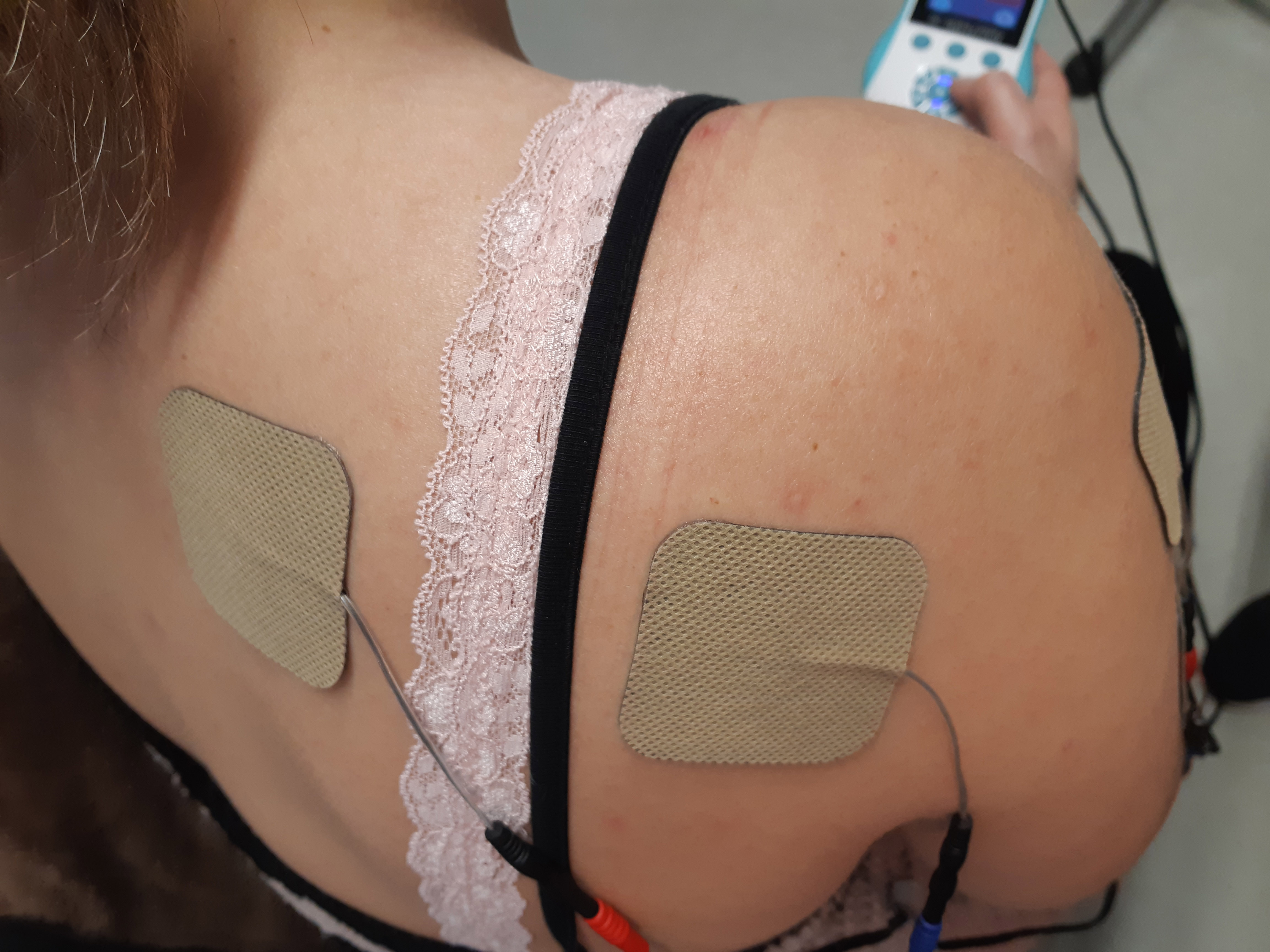 TENS - placement des électrodes TENS en cas de douleurs des